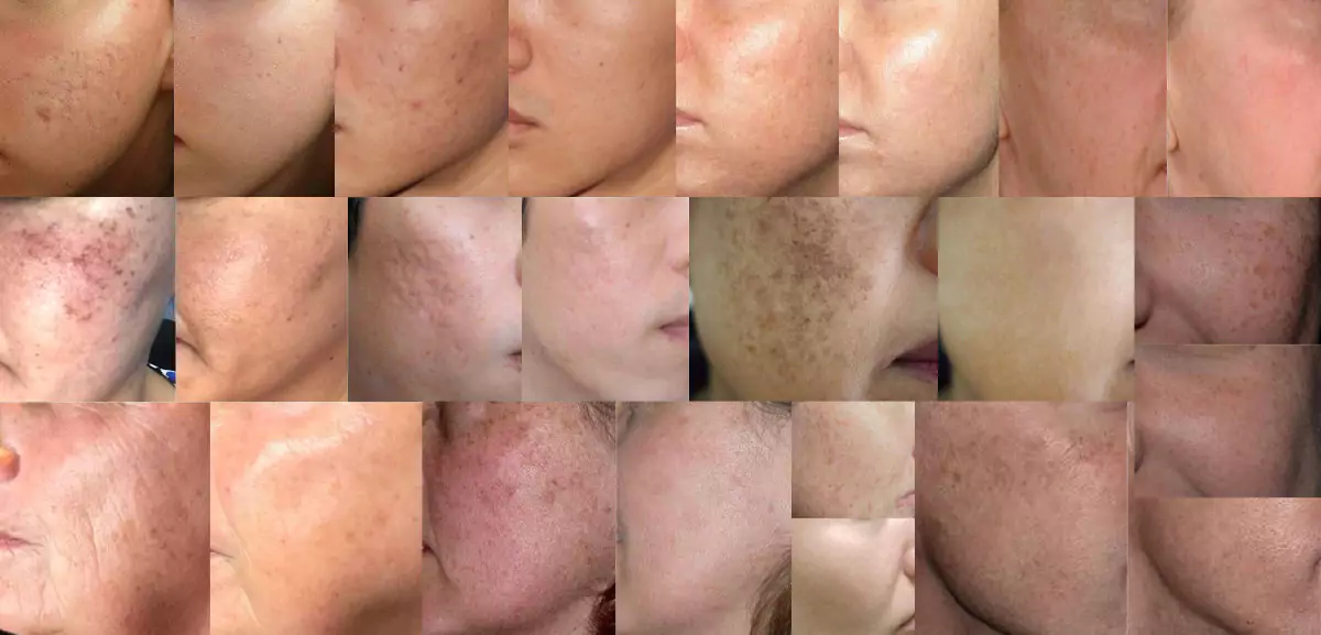 Skin-Treatment-Before-Afters-Collage