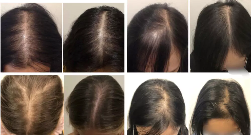 Female-Hair-Loss-Before-and-After-1