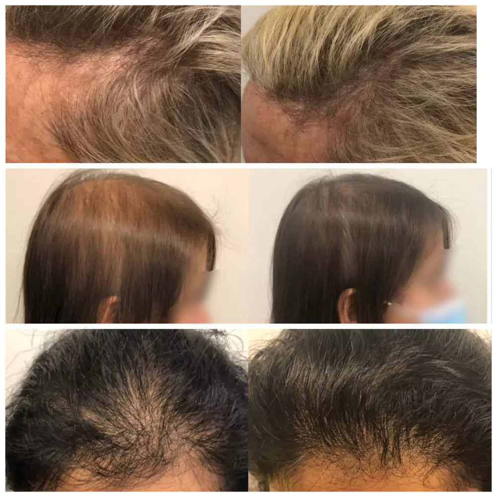 Female-Hair-Loss-Before-and-After-10