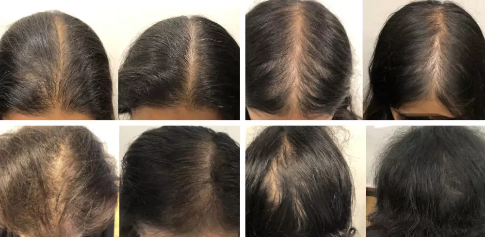 Female-Hair-Loss-Before-and-After-2