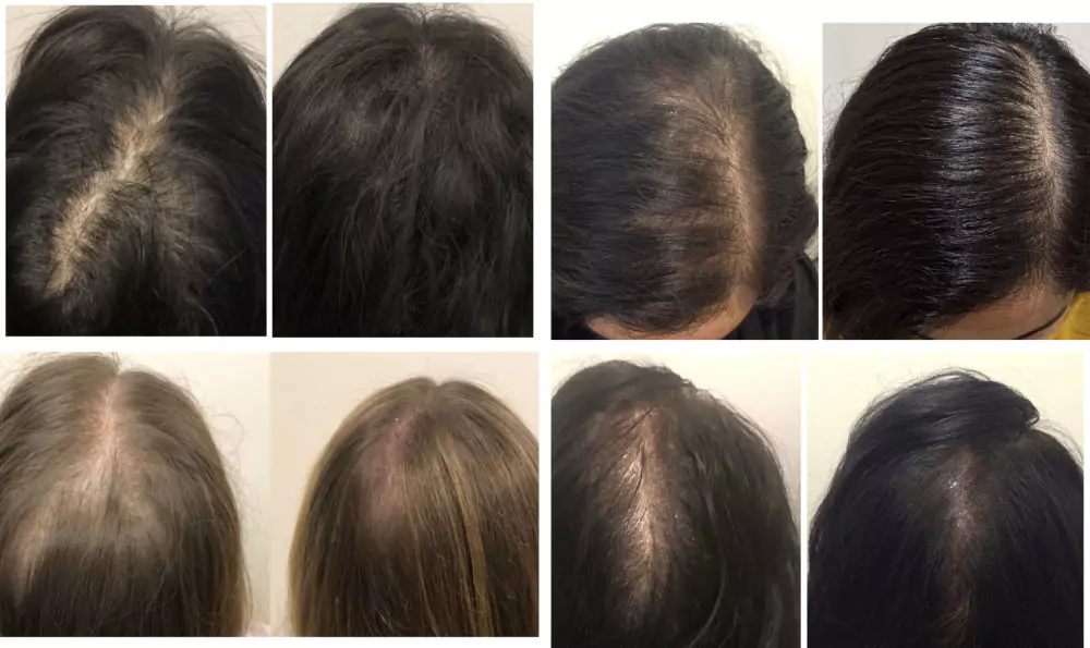 Female-Hair-Loss-Before-and-After-3