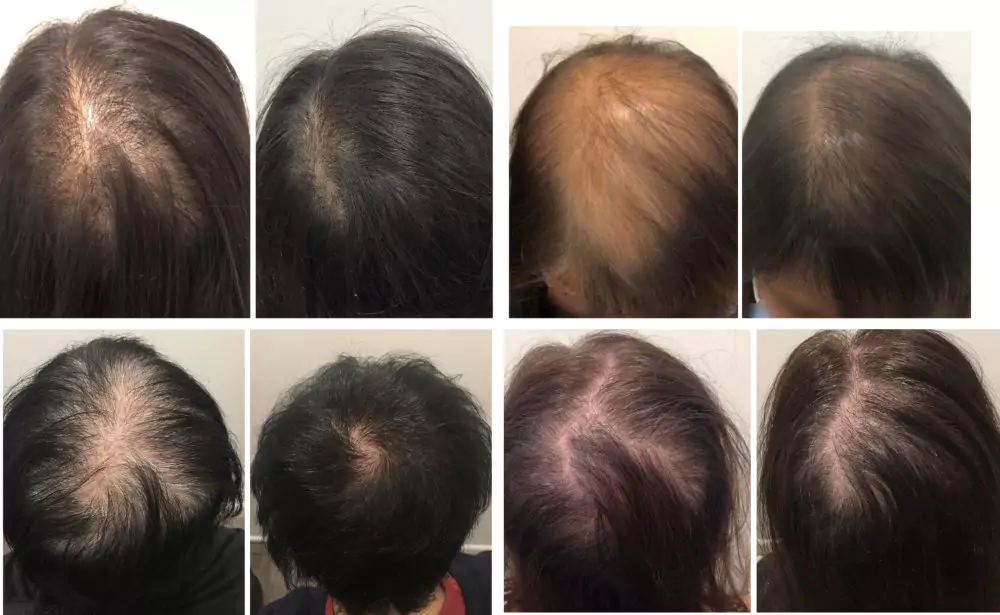 Female-Hair-Loss-Before-and-After-4