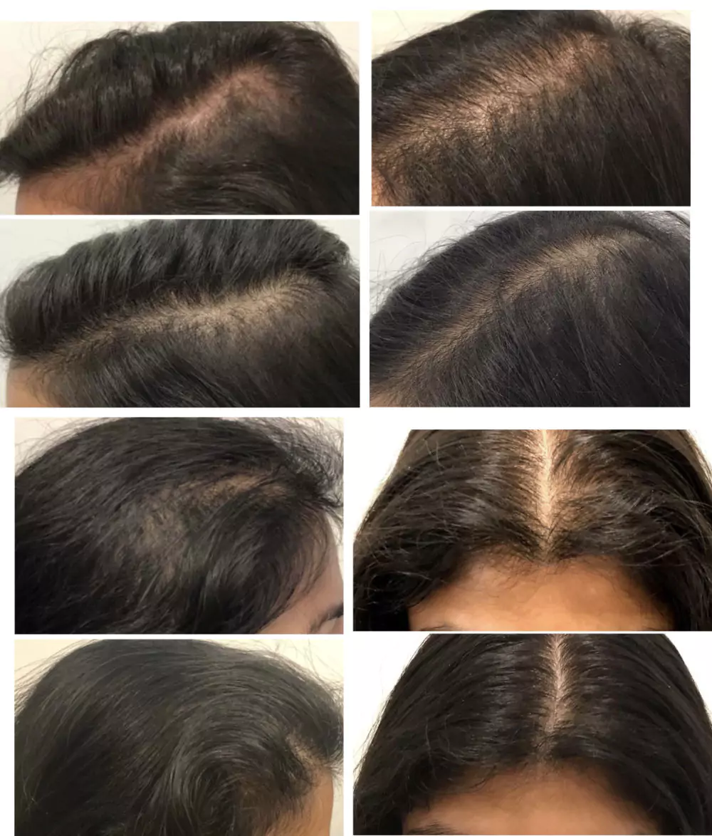 Female-Hair-Loss-Before-and-After-5