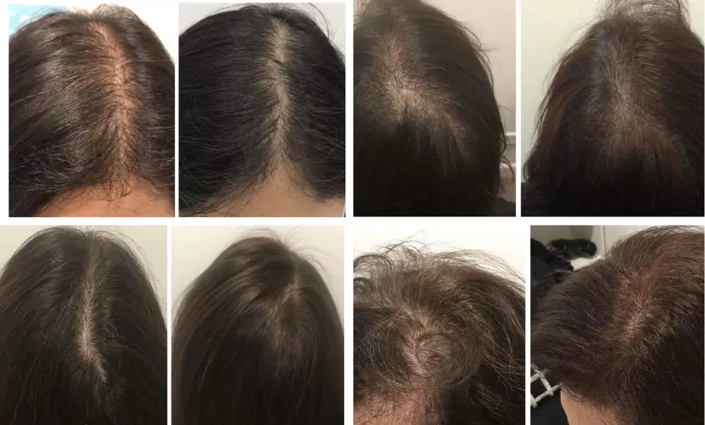 Female-Hair-Loss-Before-and-After-6