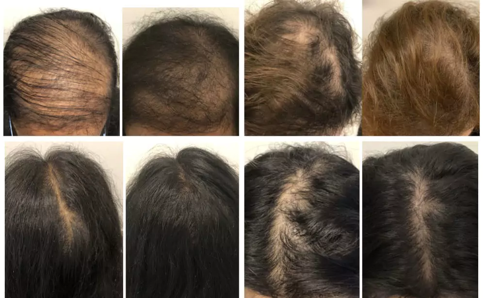 Female-Hair-Loss-Before-and-After-7