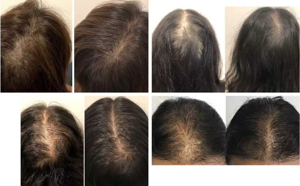 Female-Hair-Loss-Before-and-After-8