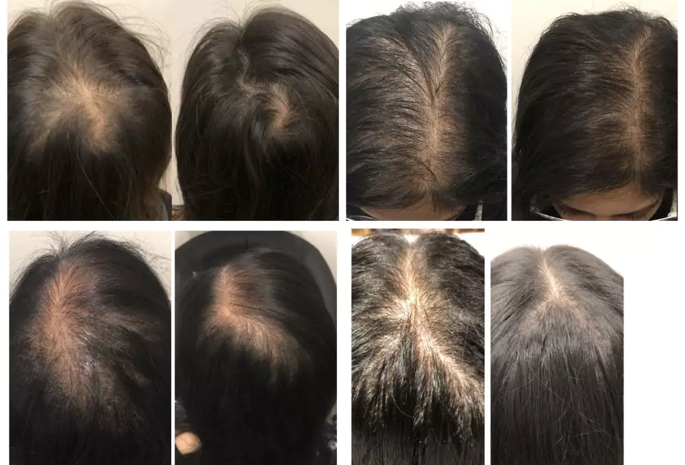 Female-Hair-Loss-Before-and-After-9