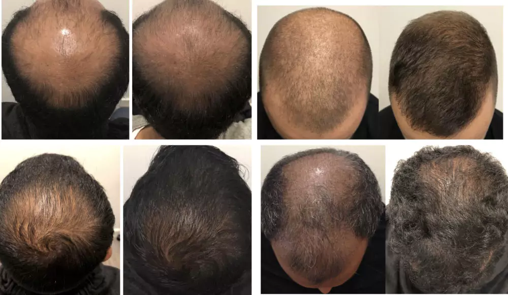 Male-Before-and-After-Photo-10