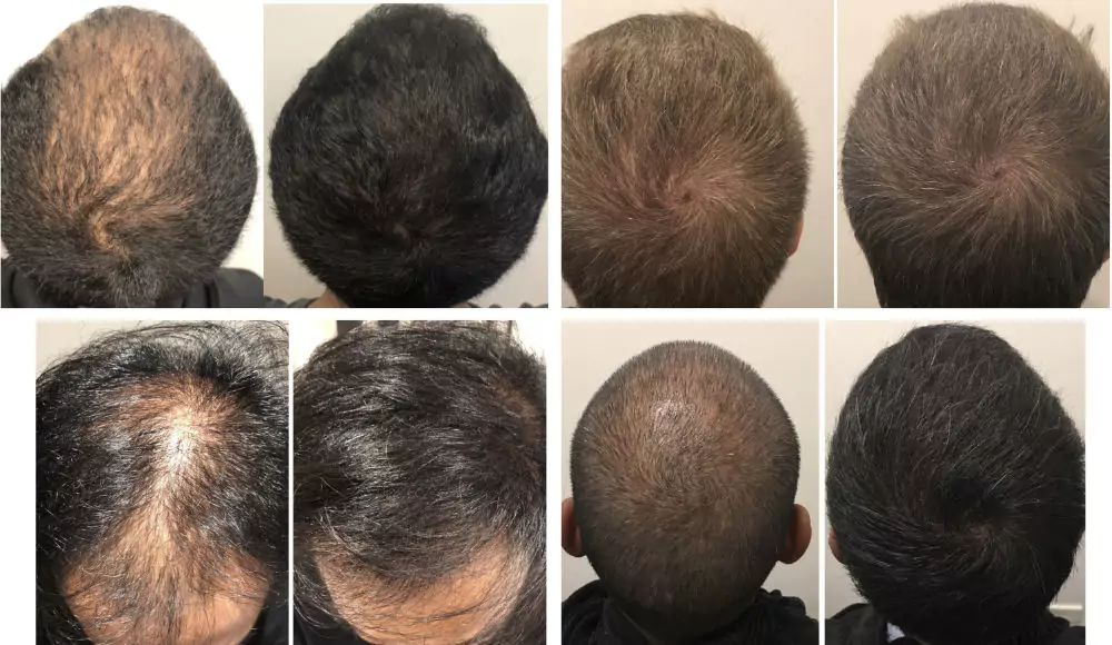 Male-Before-and-After-Photo-11