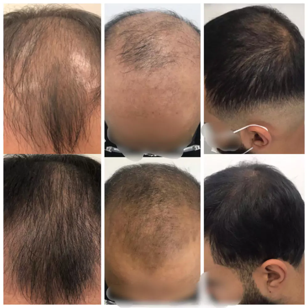 Male-Before-and-After-Photo-14