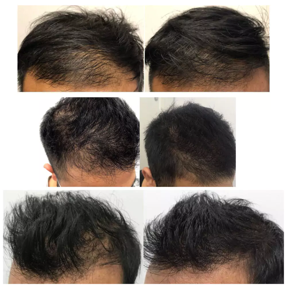 Male-Before-and-After-Photo-15